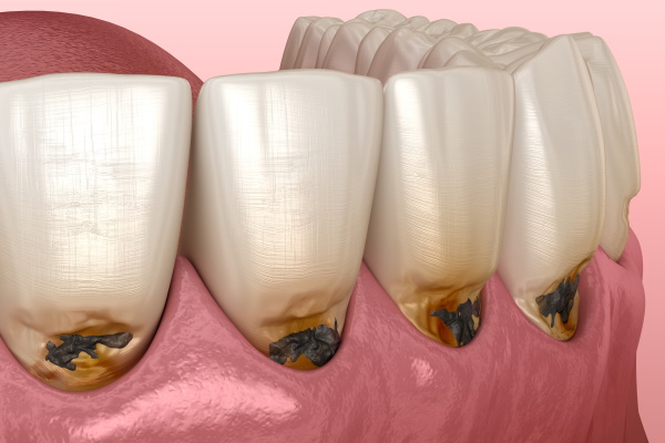 歯 の 根元 削れ 治療